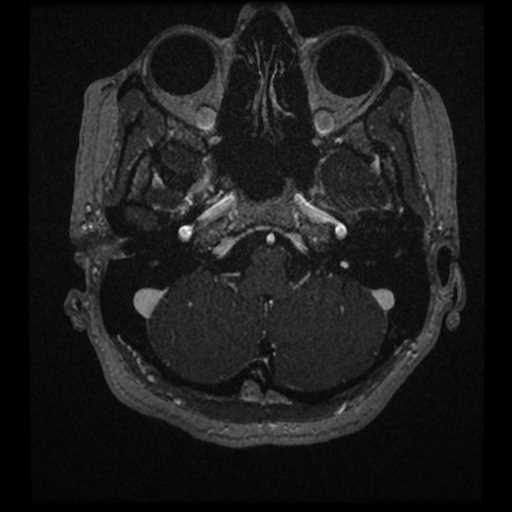 Anterior inferior cerebellar artery vascular loop - type II (Radiopaedia 70991-81209 Axial T1 C+ 72).jpg