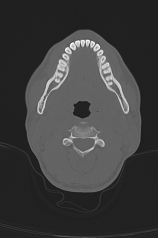 Anterior nasal spine fracture (Radiopaedia 46138-50494 Axial bone window 68).png