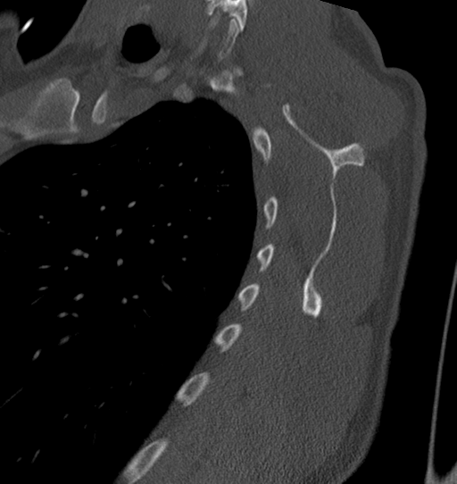 Anterior shoulder dislocation with Hill-Sachs and bony Bankart lesions (Radiopaedia 40424-42974 Sagittal bone window 47).png