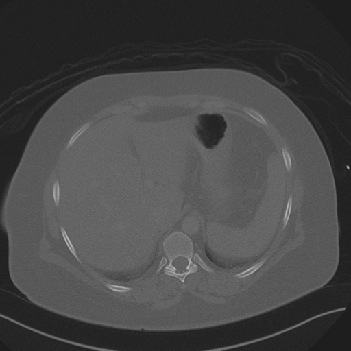 Anterior superior iliac spine avulsion fracture (Radiopaedia 44541-48244 Axial bone window 20).png