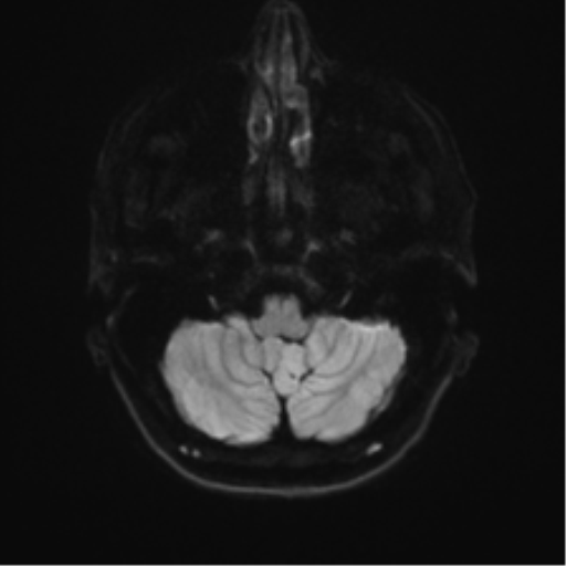 File:Anterior temporal lobe perivascular space (Radiopaedia 40946-43650 Axial DWI 31).png