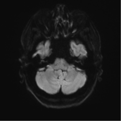 Anterior temporal pole cysts (Radiopaedia 46629-51102 Axial DWI 33).png