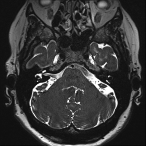 Anterior temporal pole cysts (Radiopaedia 46629-51102 Axial T2 32).png