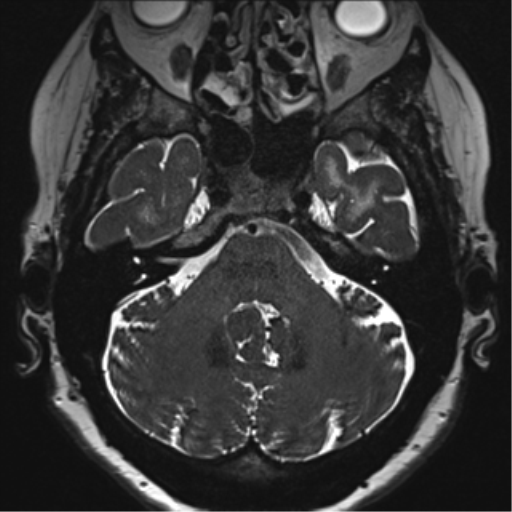 File:Anterior temporal pole cysts (Radiopaedia 46629-51102 Axial T2 36).png