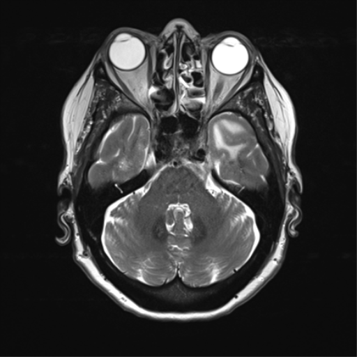 File:Anterior temporal pole cysts (Radiopaedia 46629-51102 C 11).png