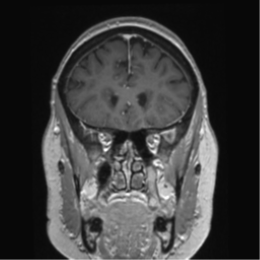 Anterior temporal pole cysts (Radiopaedia 46629-51102 Coronal T1 C+ 125).png