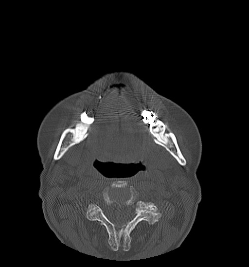 File:Anterior temporomandibular joint dislocation (Radiopaedia 59430-66784 Axial non-contrast 42).jpg