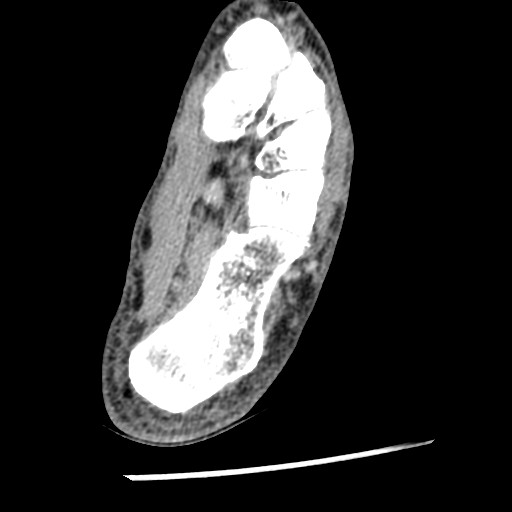 Anterior tibial artery false aneurysm (Radiopaedia 88984-105809 A 198).jpg