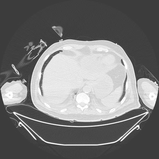 Aortic arch aneurysm (Radiopaedia 84109-99365 Axial lung window 236).jpg