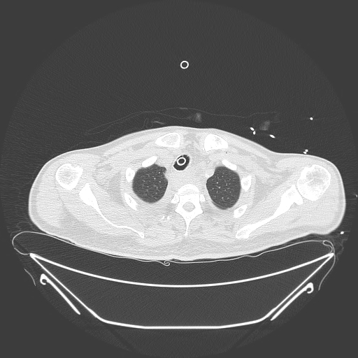 Aortic arch aneurysm (Radiopaedia 84109-99365 Axial lung window 53).jpg
