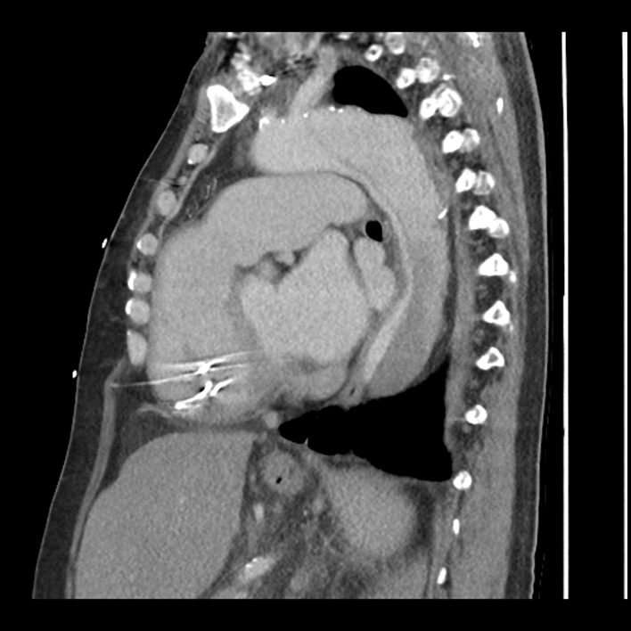 Aortic arch graft infection (FDG PET-CT) (Radiopaedia 71975-82437 C 41).jpg