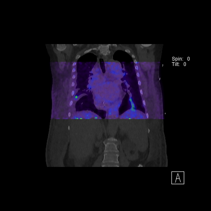 Aortic arch graft infection (FDG PET-CT) (Radiopaedia 71975-82438 D 51).jpg