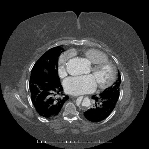 Aortic dissection- Stanford A (Radiopaedia 35729-37268 A 55).jpg