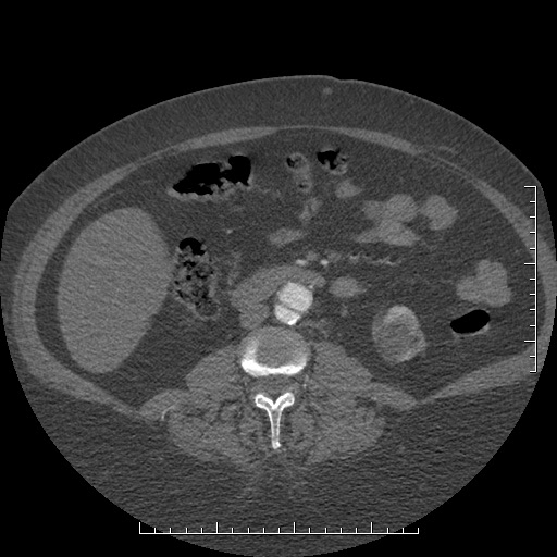File:Aortic dissection- Stanford A (Radiopaedia 35729-37268 C 18).jpg