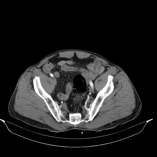 Aortic dissection- Stanford type A (Radiopaedia 22085-22085 A 71).jpg