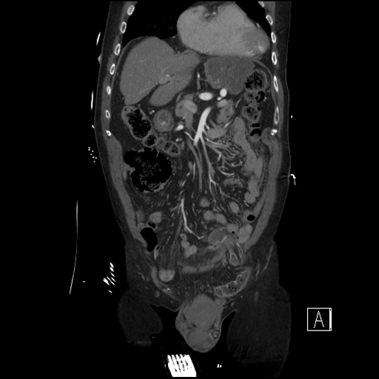 File:Aortic dissection (CTPA) (Radiopaedia 75506-86750 F 19).jpg