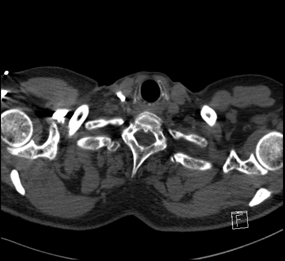 File:Aortic dissection (CTPA) (Radiopaedia 75506-86751 Axial C+ CTPA 4).jpg