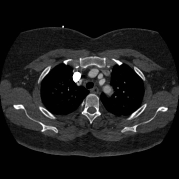 Aortic dissection (Radiopaedia 57969-64959 A 74).jpg