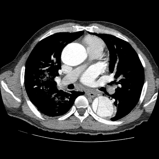 File:Aortic dissection - Stanford A -DeBakey I (Radiopaedia 28339-28587 B 43).jpg
