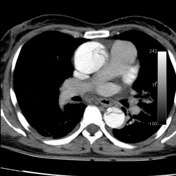 Aortic dissection - Stanford type A (Radiopaedia 29247-29659 A 38).jpg