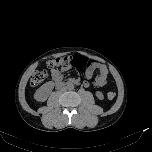 Aortic dissection - Stanford type A (Radiopaedia 83418-98500 Axial non-contrast 60).jpg