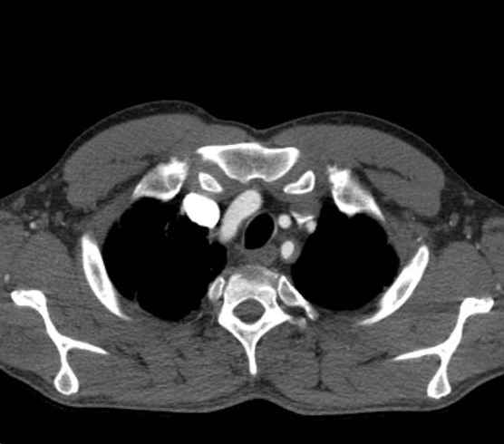 File:Aortic dissection - Stanford type B (Radiopaedia 73648-84437 A 1).jpg