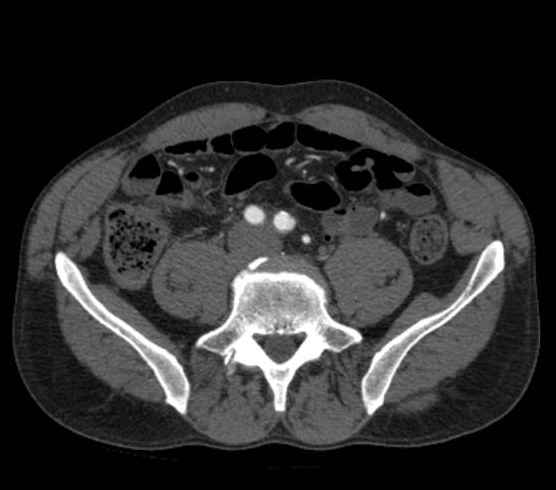 Aortic dissection - Stanford type B (Radiopaedia 73648-84437 A 201).jpg