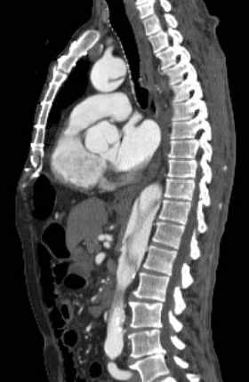 File:Aortic dissection - Stanford type B (Radiopaedia 73648-84437 C 73).jpg