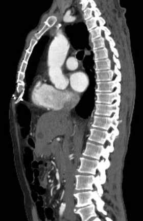 File:Aortic dissection - Stanford type B (Radiopaedia 73648-84437 C 83).jpg