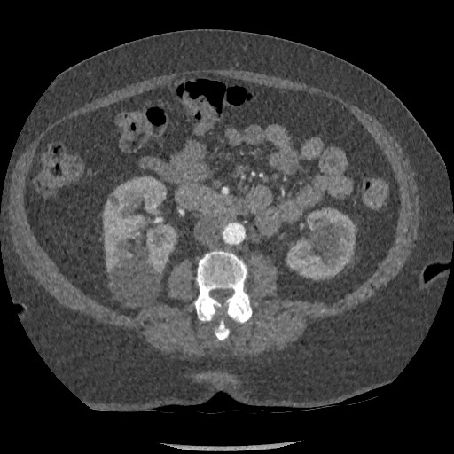 Aortic dissection - Stanford type B (Radiopaedia 88281-104910 A 121).jpg
