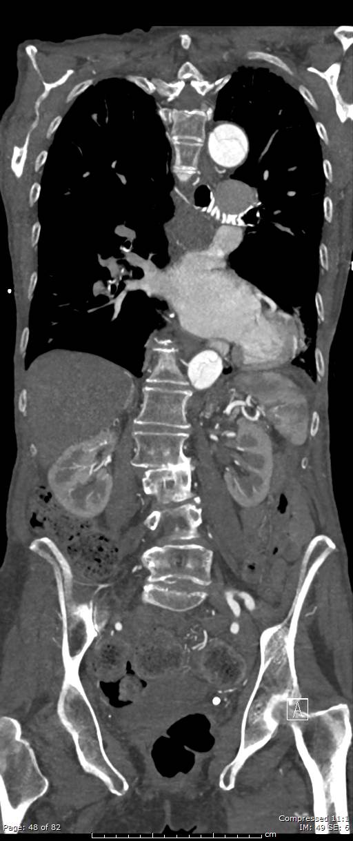 Aortic dissection with extension into aortic arch branches (Radiopaedia 64402-73204 A 48).jpg