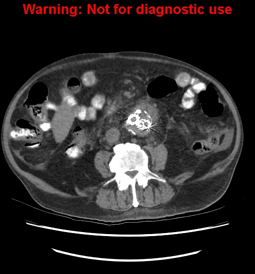 Aortic graft infection (Radiopaedia 44979-48907 Axial non-contrast 55).jpg