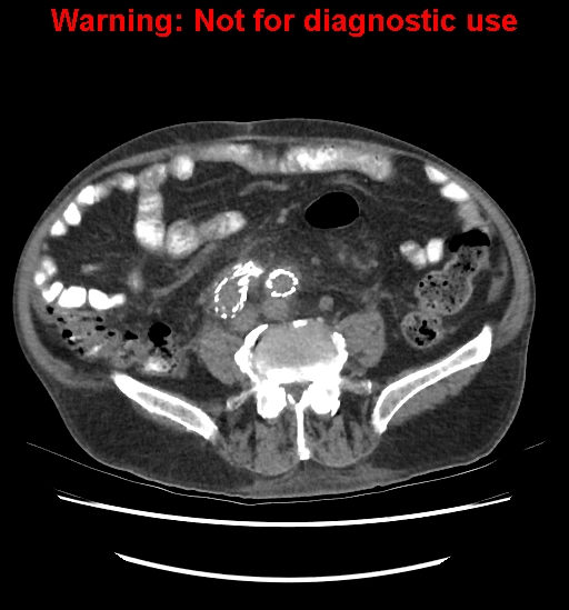 File:Aortic graft infection (Radiopaedia 44979-48907 Axial non-contrast 61).jpg