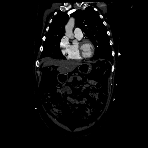 Aortic intramural hematoma (Radiopaedia 34260-35540 C 25).png