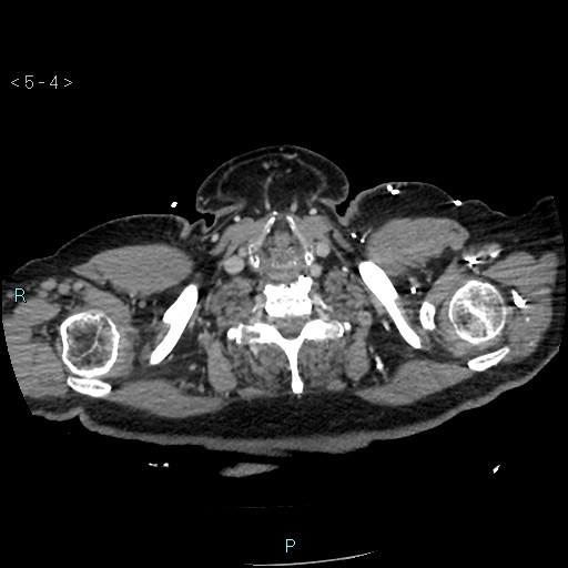 Aortic intramural hematoma (Radiopaedia 48463-53380 C 4).jpg