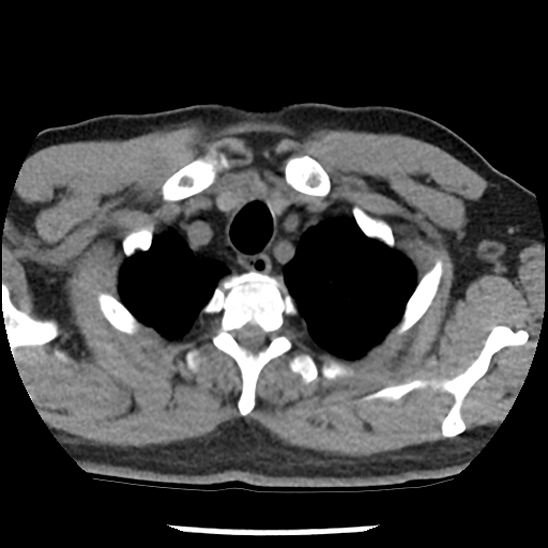 Aortic intramural hematoma (type B) (Radiopaedia 79323-92387 Axial non-contrast 3).jpg