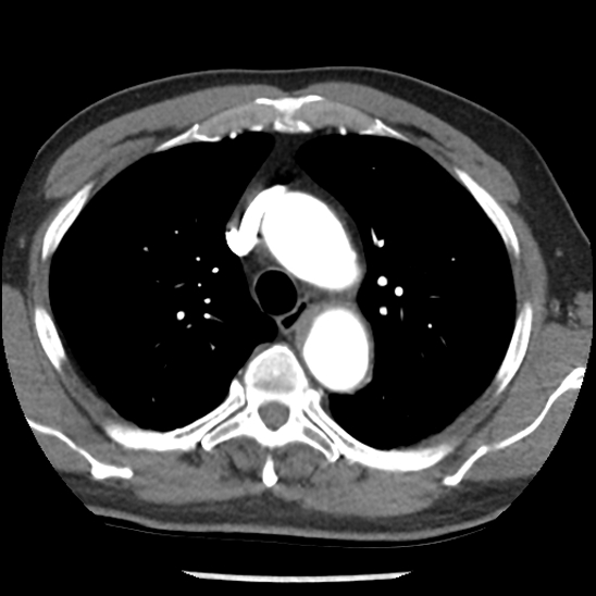Aortic intramural hematoma (type B) (Radiopaedia 79323-92387 B 15).jpg