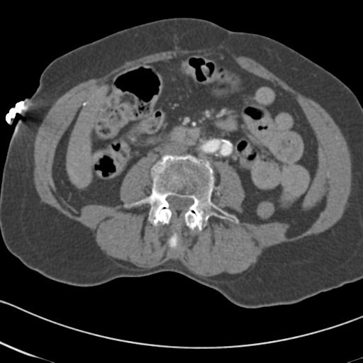Aortic intramural hematoma from penetrating atherosclerotic ulcer (Radiopaedia 31137-31836 A 117).jpg