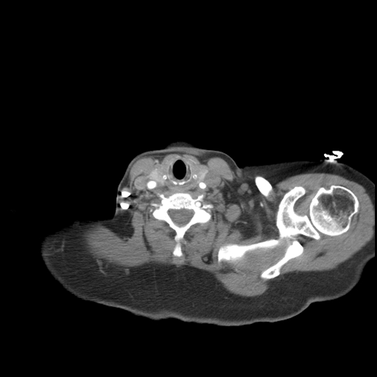 Aortic intramural hematoma with dissection and intramural blood pool (Radiopaedia 77373-89491 B 16).jpg