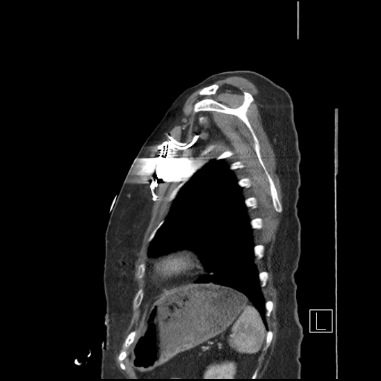 Aortic intramural hematoma with dissection and intramural blood pool (Radiopaedia 77373-89491 D 75).jpg