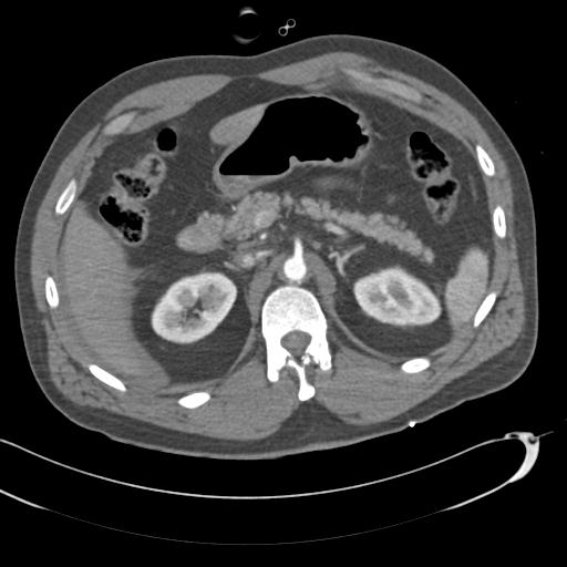 Aortic transection, diaphragmatic rupture and hemoperitoneum in a complex multitrauma patient (Radiopaedia 31701-32622 A 95).jpg