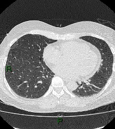 File:Aortic valve endocarditis (Radiopaedia 87209-103485 Axial lung window 65).jpg