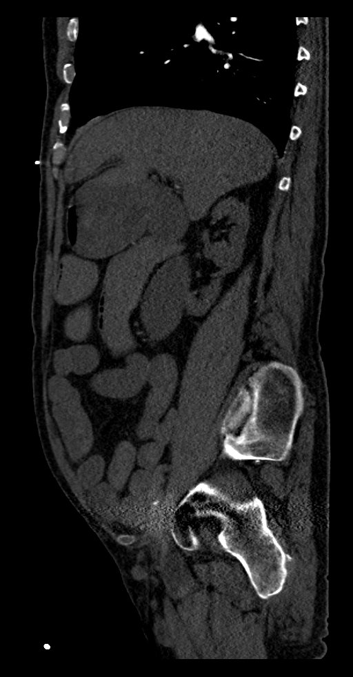 Aortoduodenal fistula (Radiopaedia 75286-86415 F 47).jpg