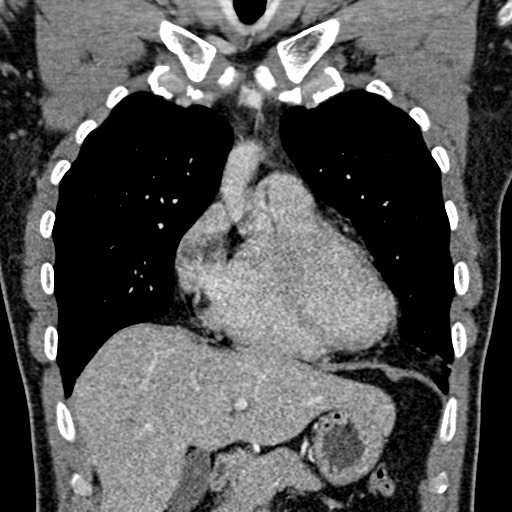 Apical lung mass mimic - neurogenic tumor (Radiopaedia 59918-67521 B 48).jpg
