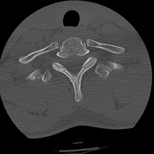 File:Apical pneumothorax on cervical spine CT (Radiopaedia 45343-49368 Axial bone window 79).jpg