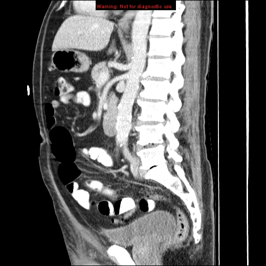 File:Appendicitis mass in inguinal hernia (Radiopaedia 26858-27029 C 29).jpg