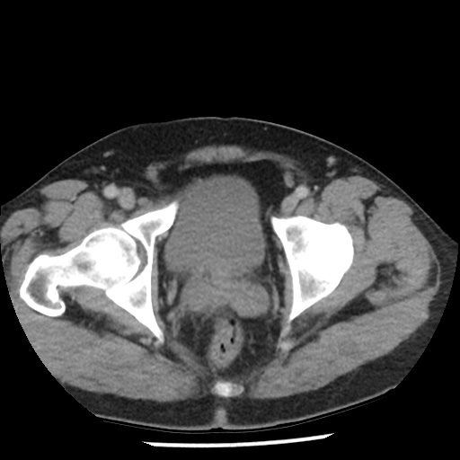 Appendicitis with perforation (Radiopaedia 35790-37342 A 49).jpg