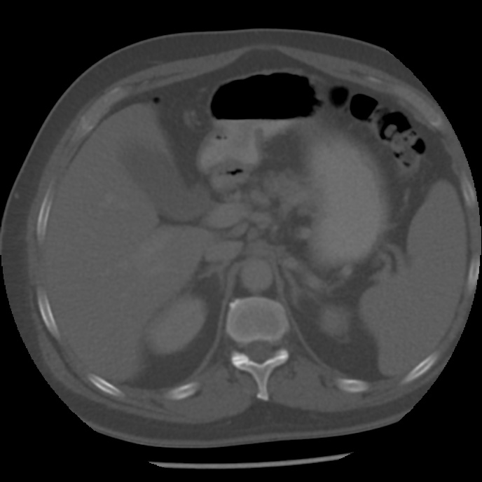 Appendicitis with perforation (Radiopaedia 35790-37342 Axial bone window 13).jpg