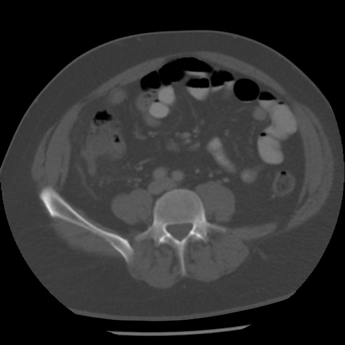 Appendicitis with perforation (Radiopaedia 35790-37342 Axial bone window 32).jpg