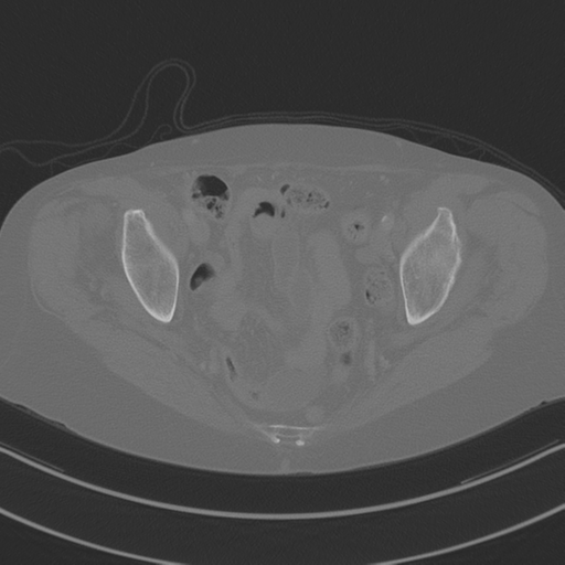 April fools' 2019- calcified peritoneal arachnoidosis (Radiopaedia 67273-76636 Axial bone window 48).png